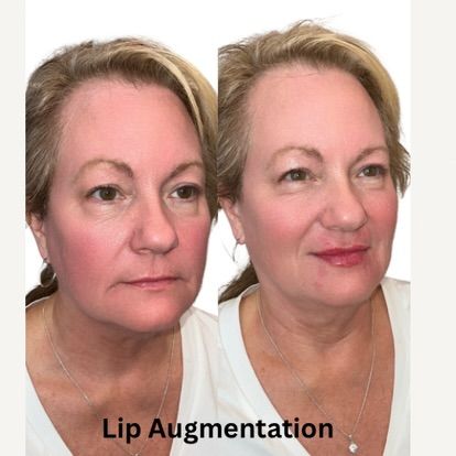 Side-by-side comparison shows a woman's face before and after lip augmentation. Her lips appear fuller in the second image.