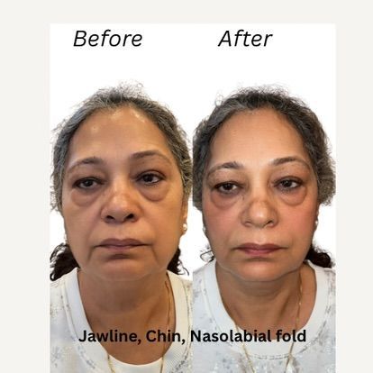Comparison: Face before and after cosmetic procedure, showing less jawline sagging and nasolabial folds.