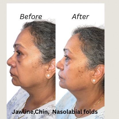 Before and after facial rejuvenation. Reduction of jawline, chin, and nasolabial folds.