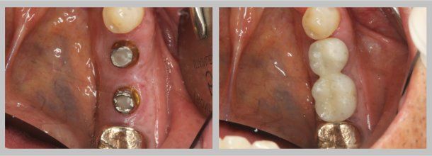 Implant: Before/After