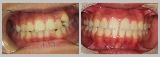 Braces: Before/After