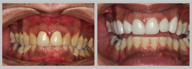 Crowns: Before/After