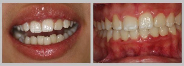 Braces: Before/After