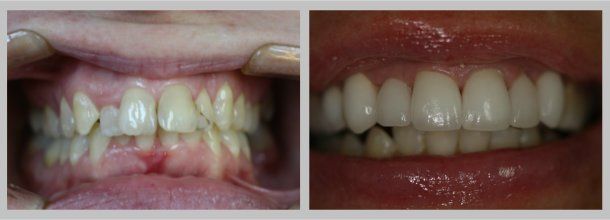 Crowns: Before/After