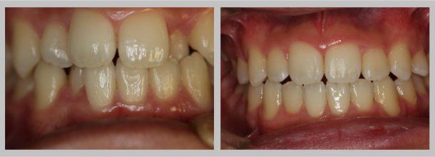 Braces: Before/After