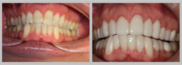 Lumineers: Before/After