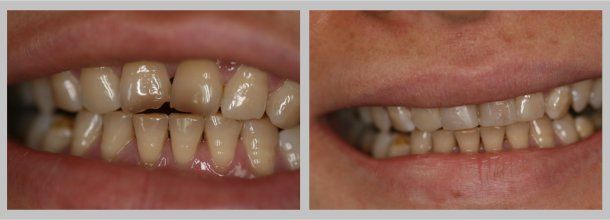 Bonding: Before/After