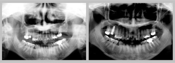 Implant Panoramic: Before/After