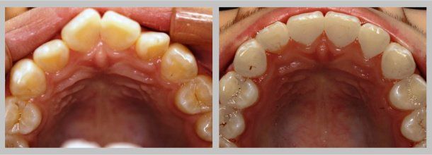 Braces: Before/After