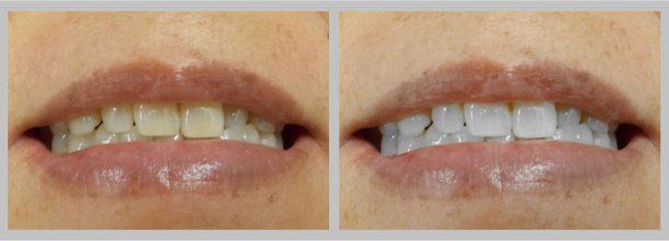 Teeth Whitening: Before/After