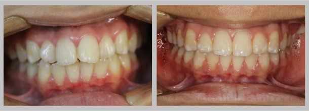Brace: Before/After