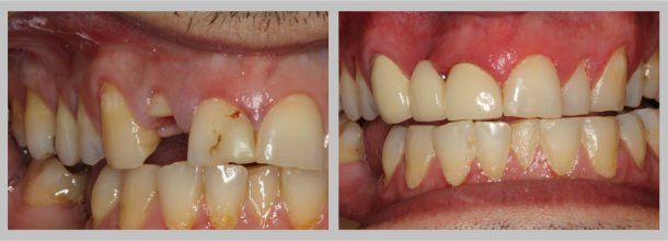 Bridge: Before/After