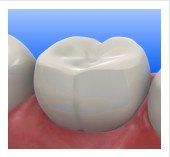 Composite and Tooth Color Fillings Las Vegas, NV