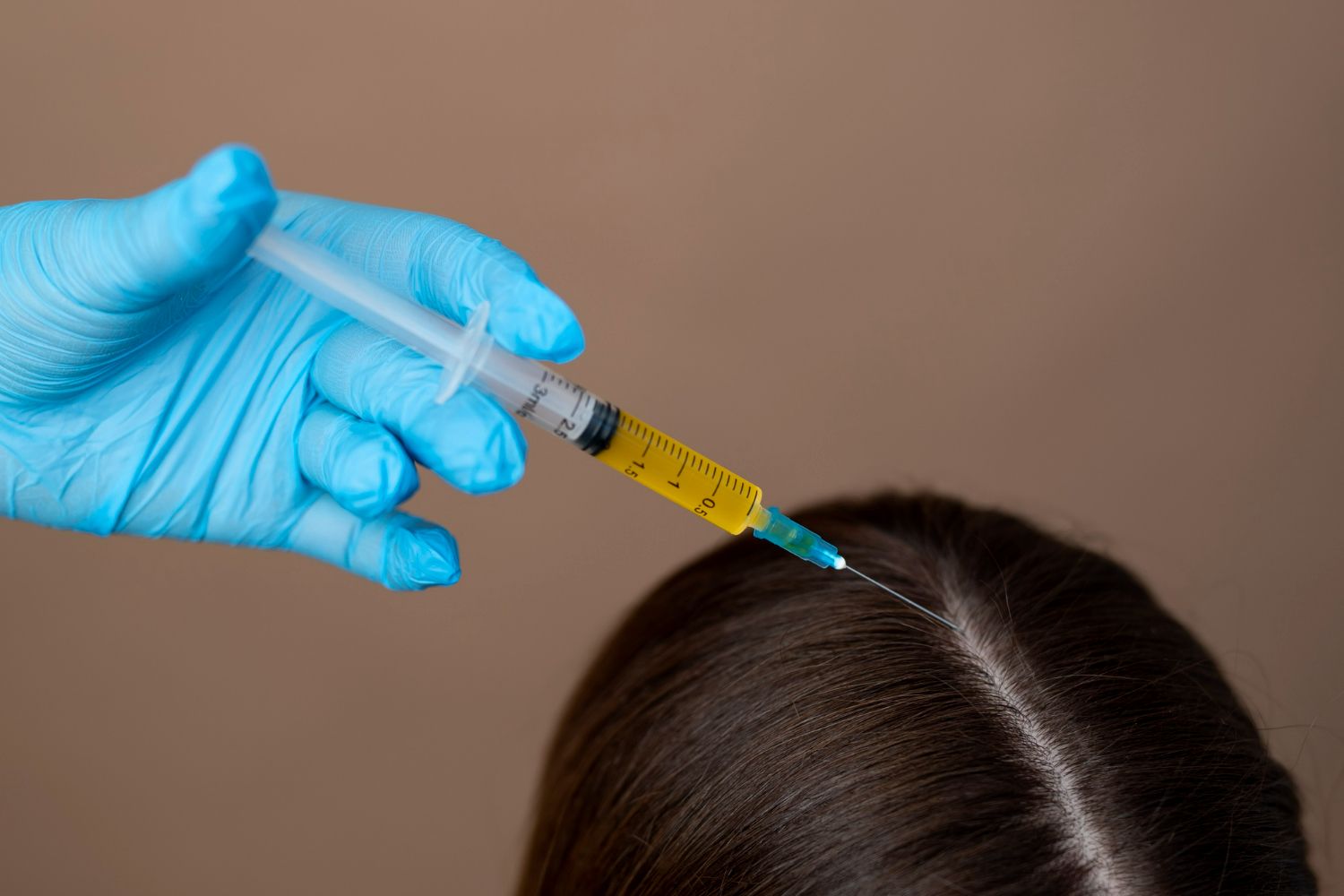 Gloved hand injecting a syringe filled with yellow liquid into a person's scalp, likely for hair treatment.