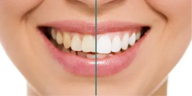 A smile with a before and after comparison of teeth whitening. One side is yellow, the other white.