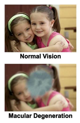 Photo of Blurry Vision - Macular Degeneration in