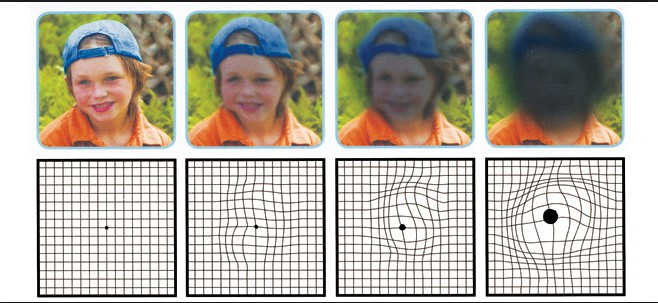 Progression of Macular Degeneration - Macular Degeneration in Little Rock, AR