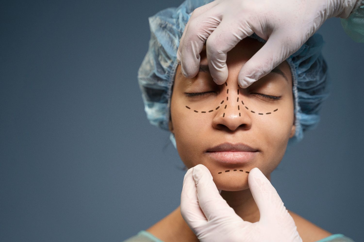 A woman is getting a nose surgery with lines drawn on her face.