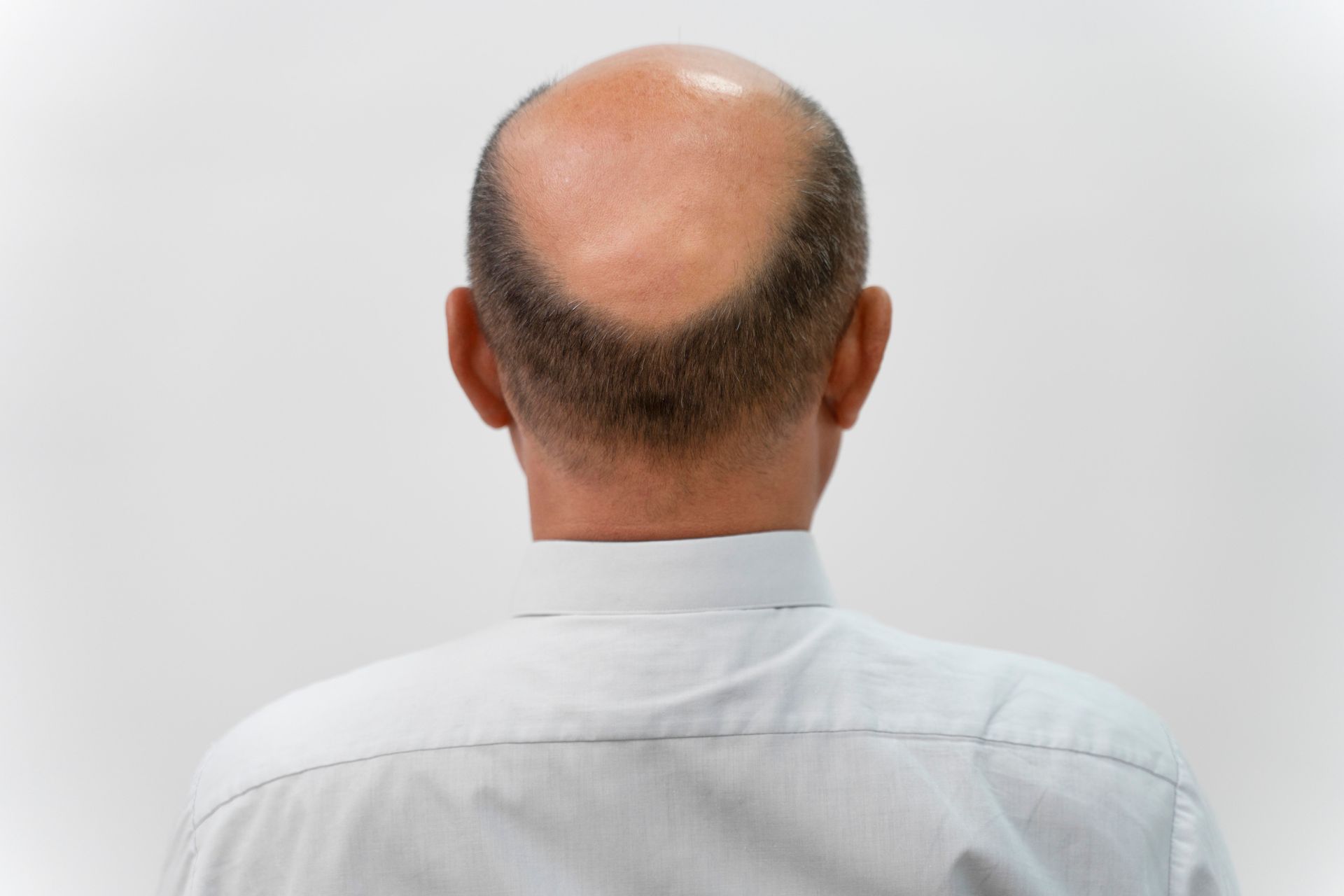 Man's head, viewed from the back, showing a bald spot shaped like an inverted V; gray shirt.