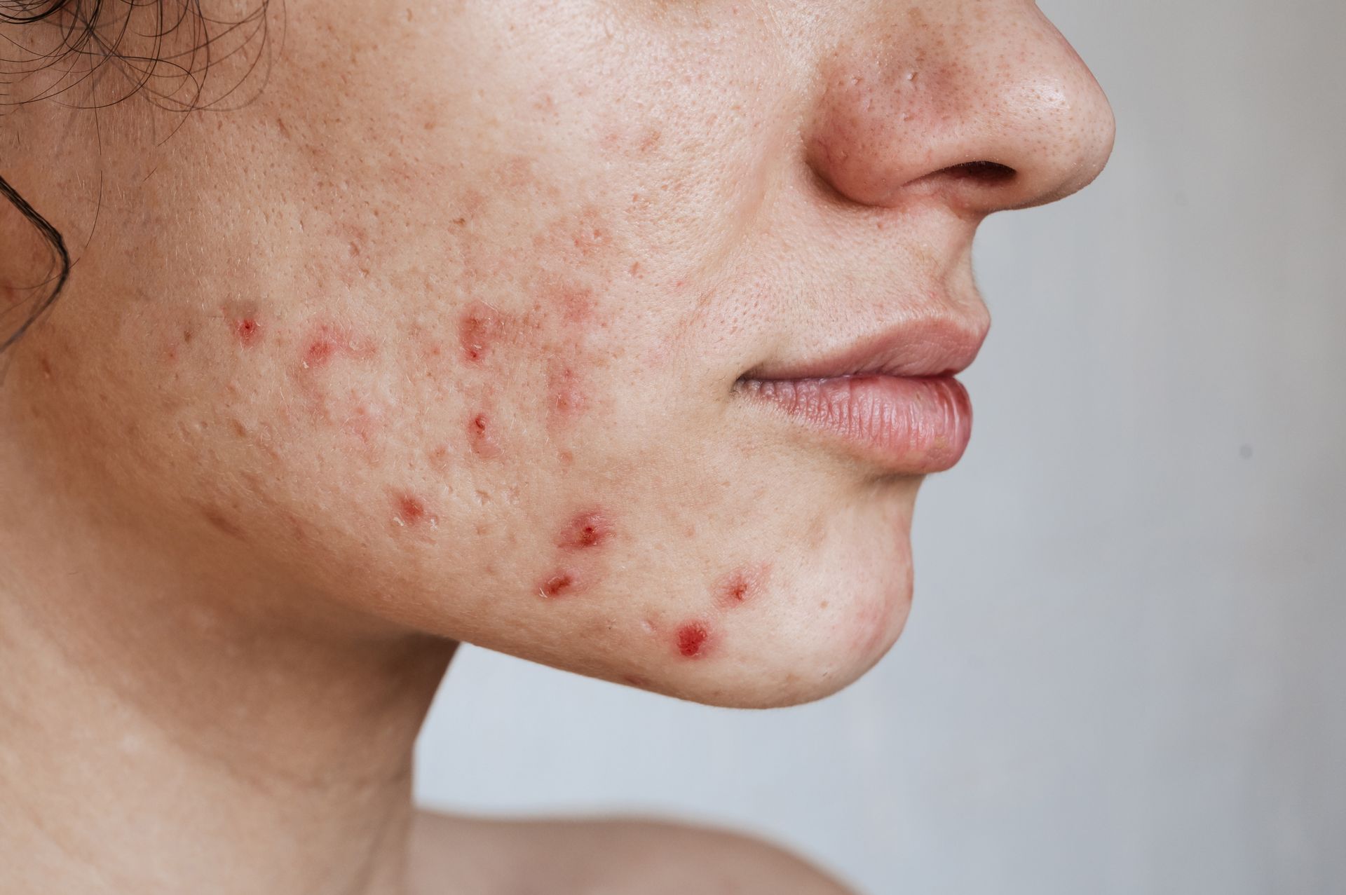 Close-up of a person's face showing skin with multiple red, inflamed acne spots.