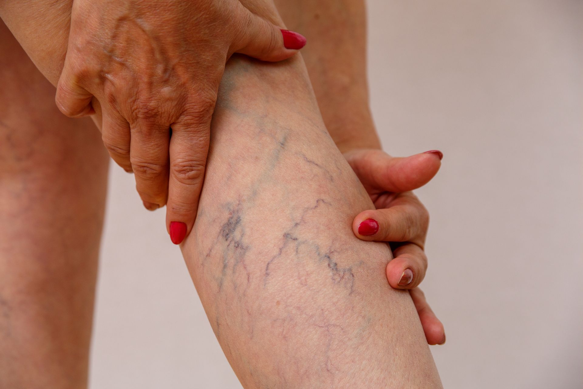 Leg with visible blue veins being examined by hands with red nail polish.