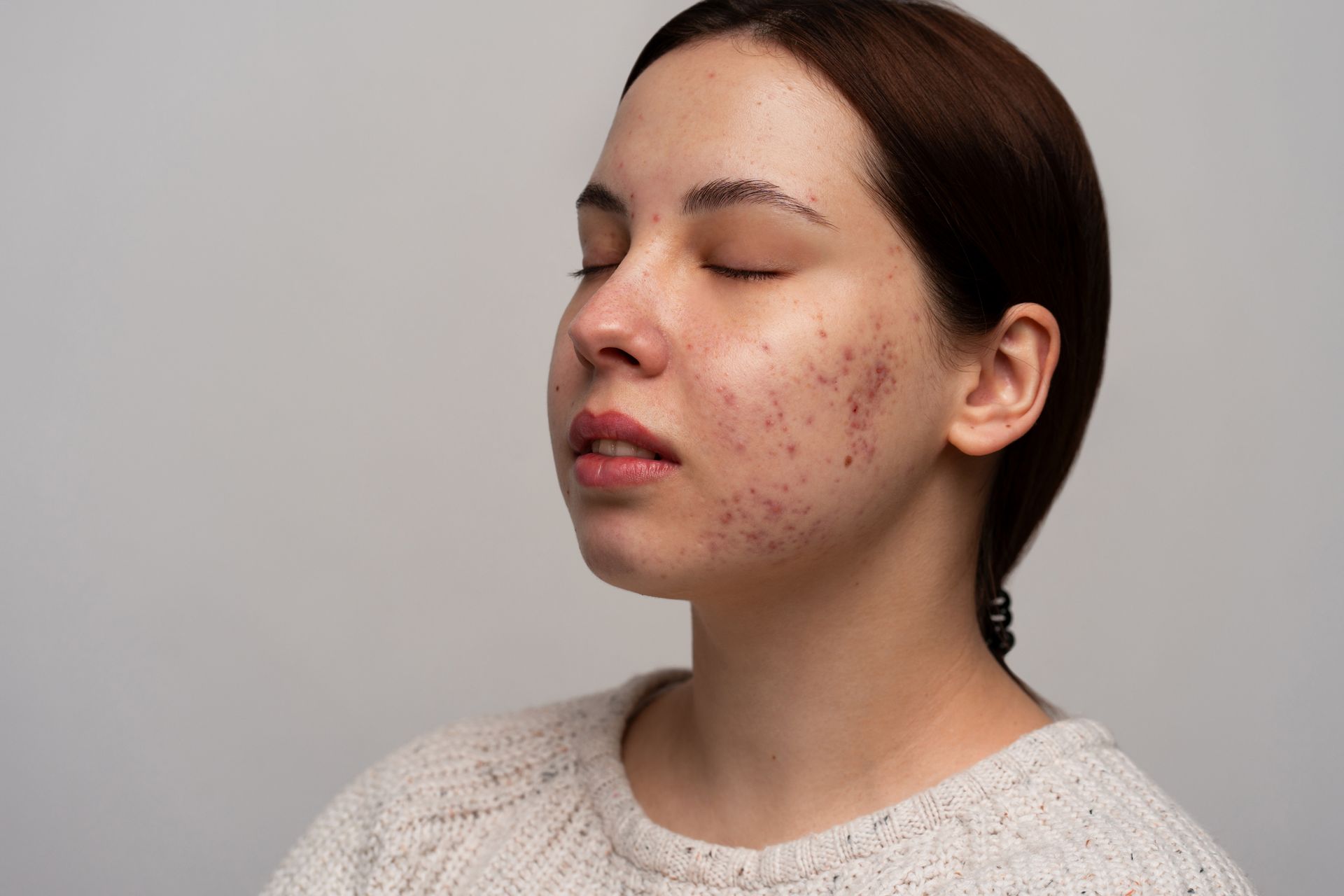 Woman with closed eyes and acne on her face, in front of a gray backdrop.