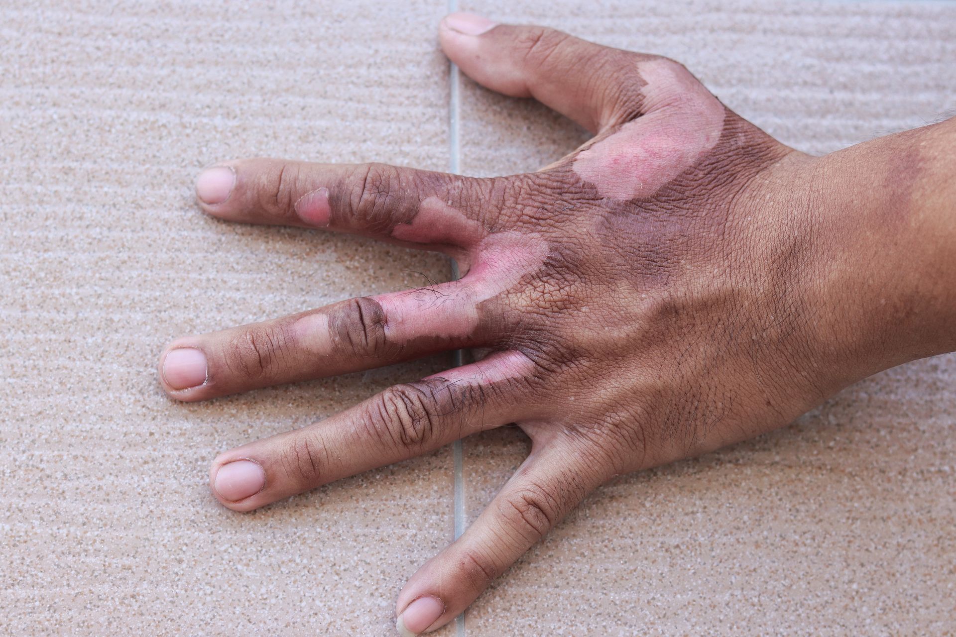 Hand with areas of dark, discolored skin and blisters, suggesting burn injury.