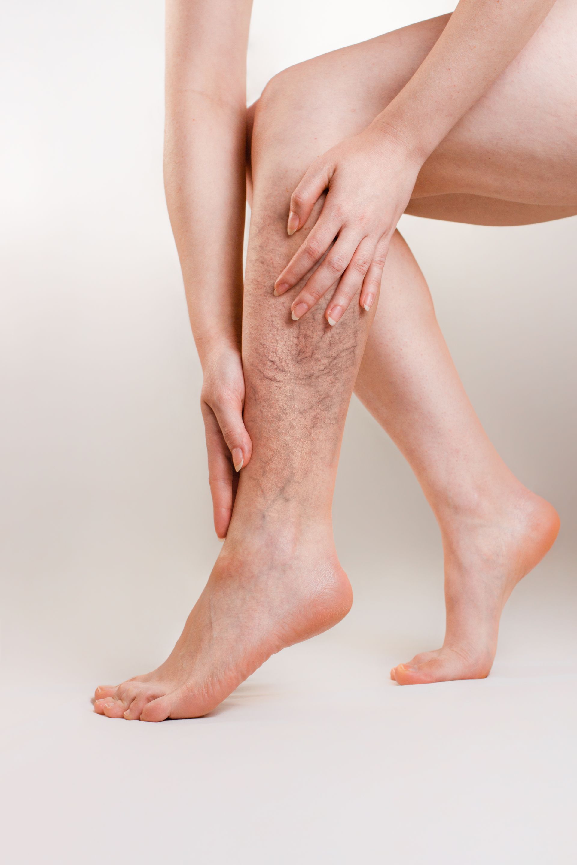 Leg with varicose veins, hand touching leg.