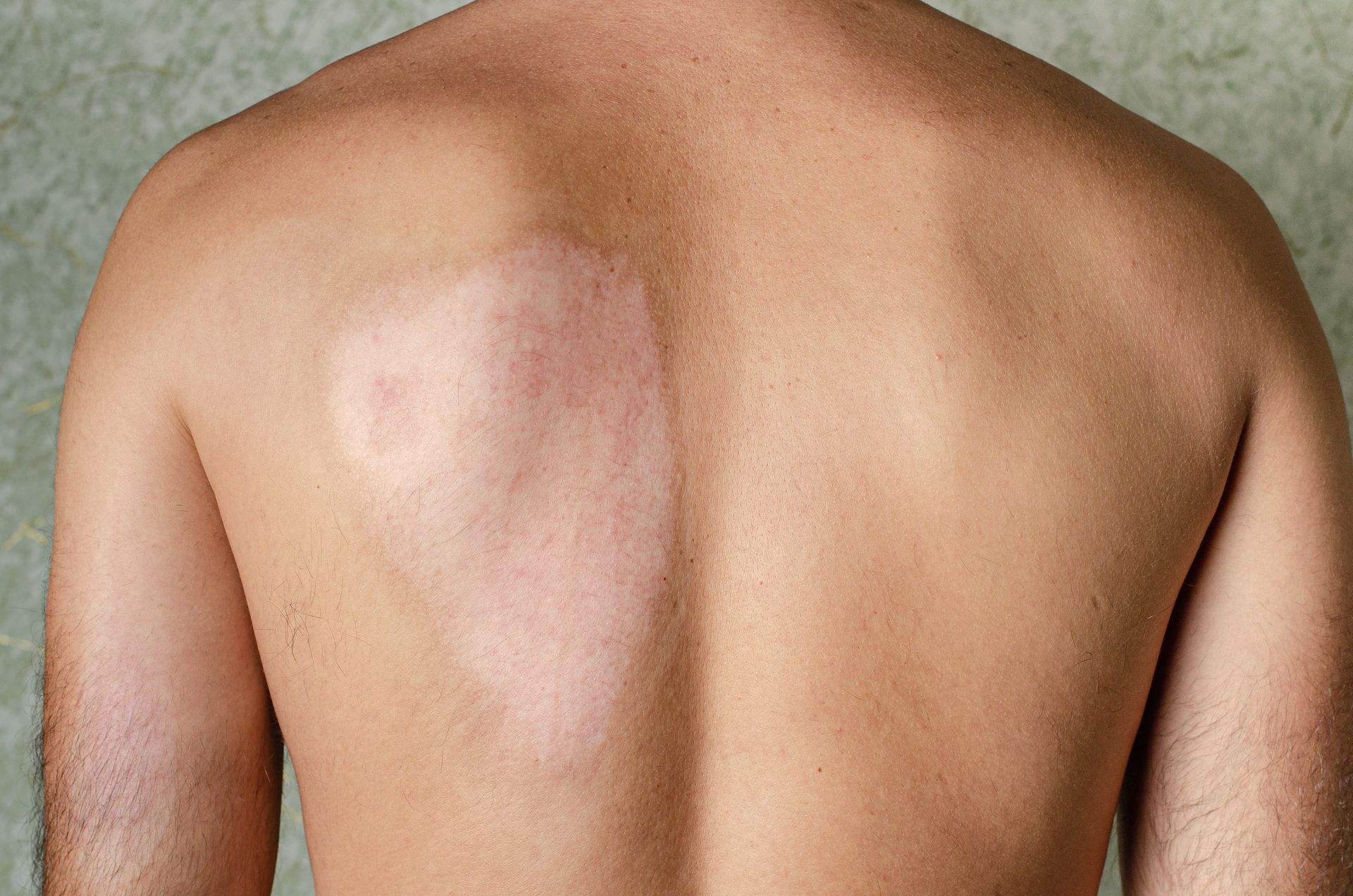 Back of a person with a large, pink, circular rash on their left side.