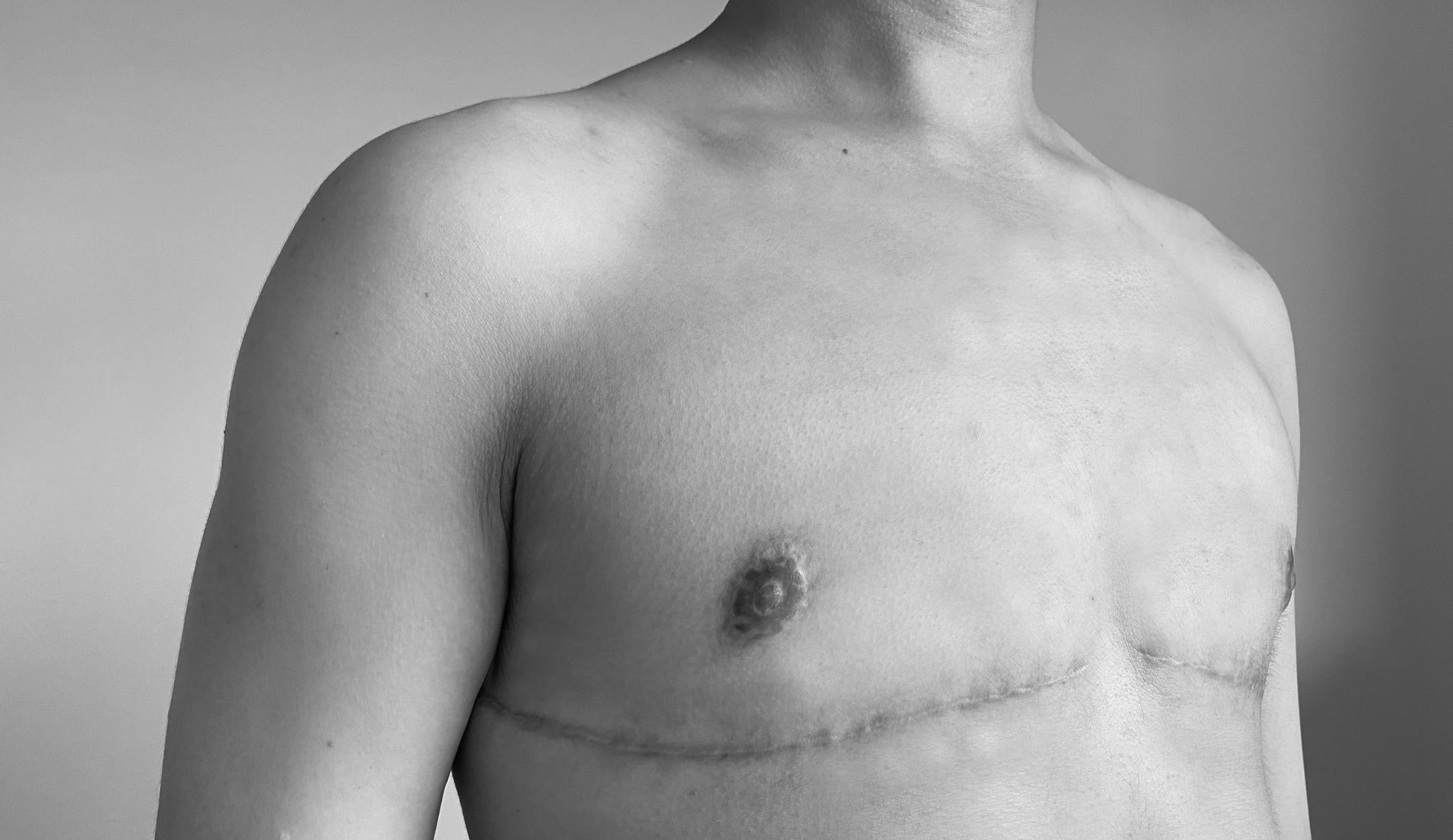 Chest of a person, post-mastectomy with visible horizontal scars.