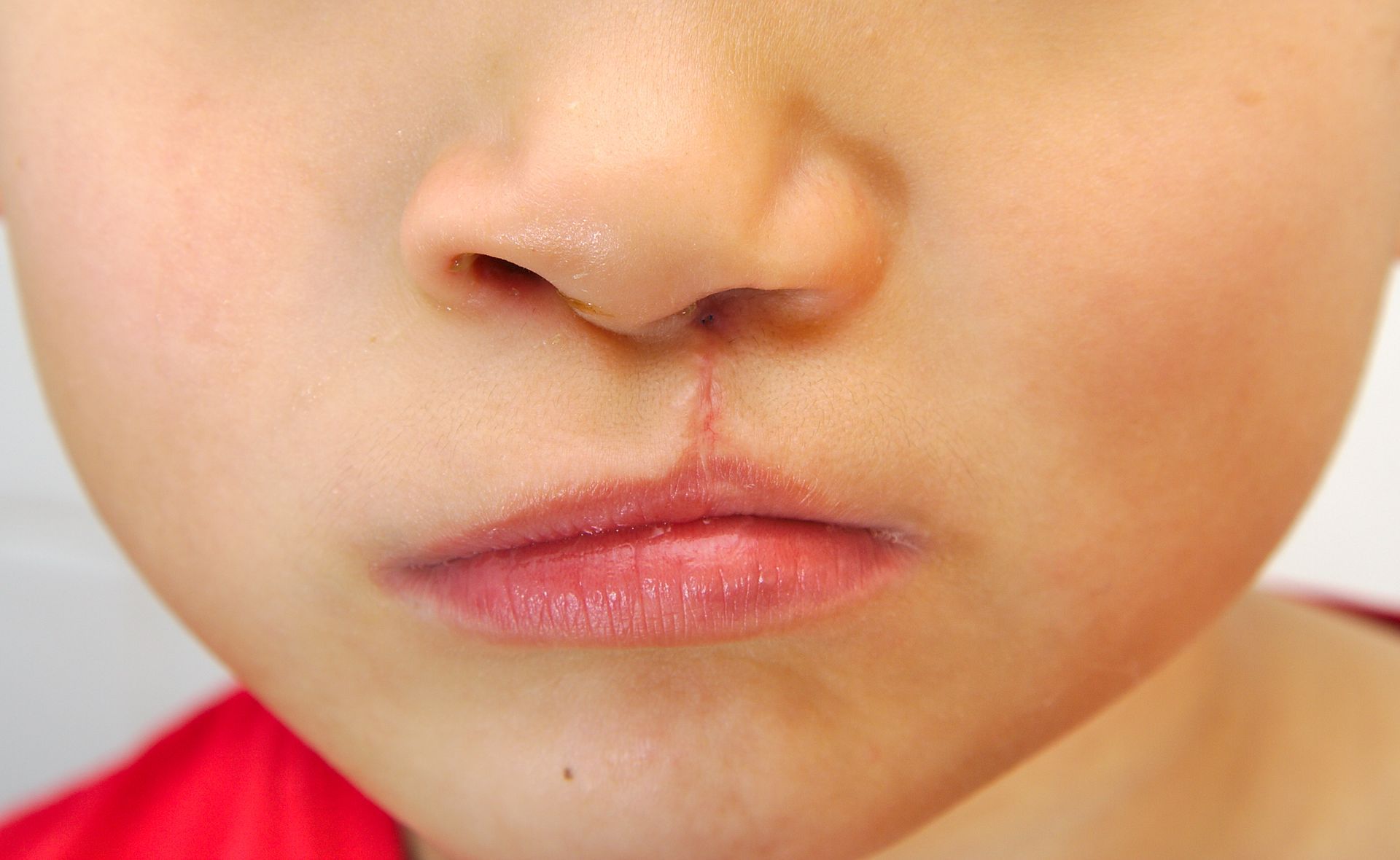 Close-up of a child's face with a cleft lip, centered on the nose and mouth.