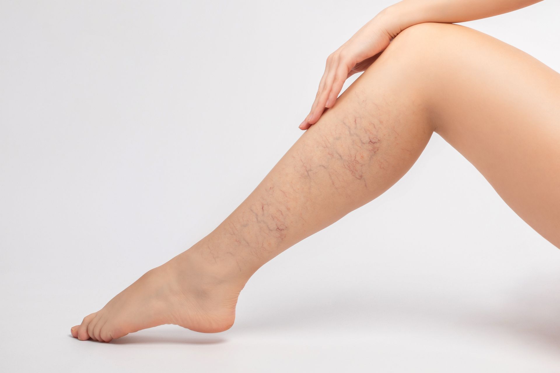 Leg with visible spider veins on a light background. Hand rests on the thigh.