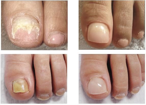 Nail Restoration — Country Podiatry in South Tamworth, NSW
