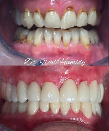 A before and after photo of a person 's teeth by dr. wal hamidy