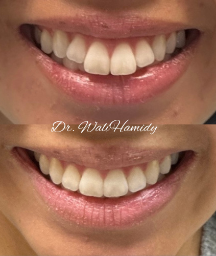 A close up of a woman 's mouth with white teeth and pink lips.