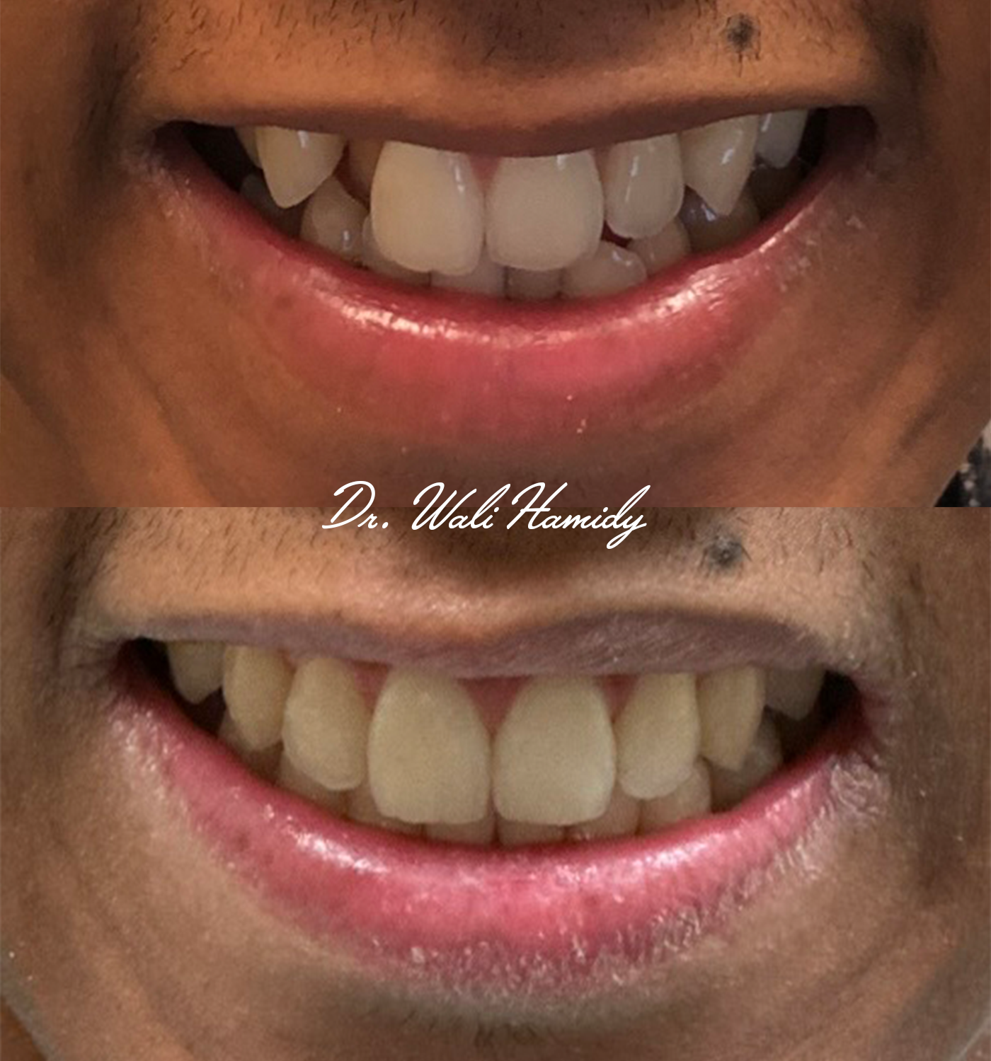 Invisalign Before & Afters