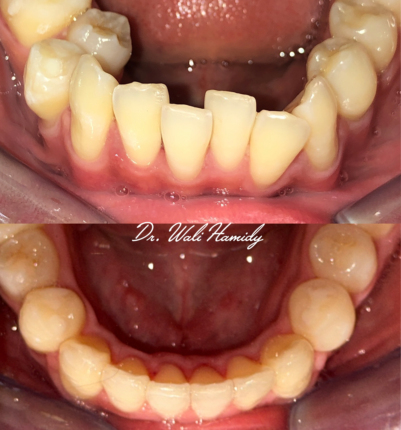 Invisalign Before & Afters