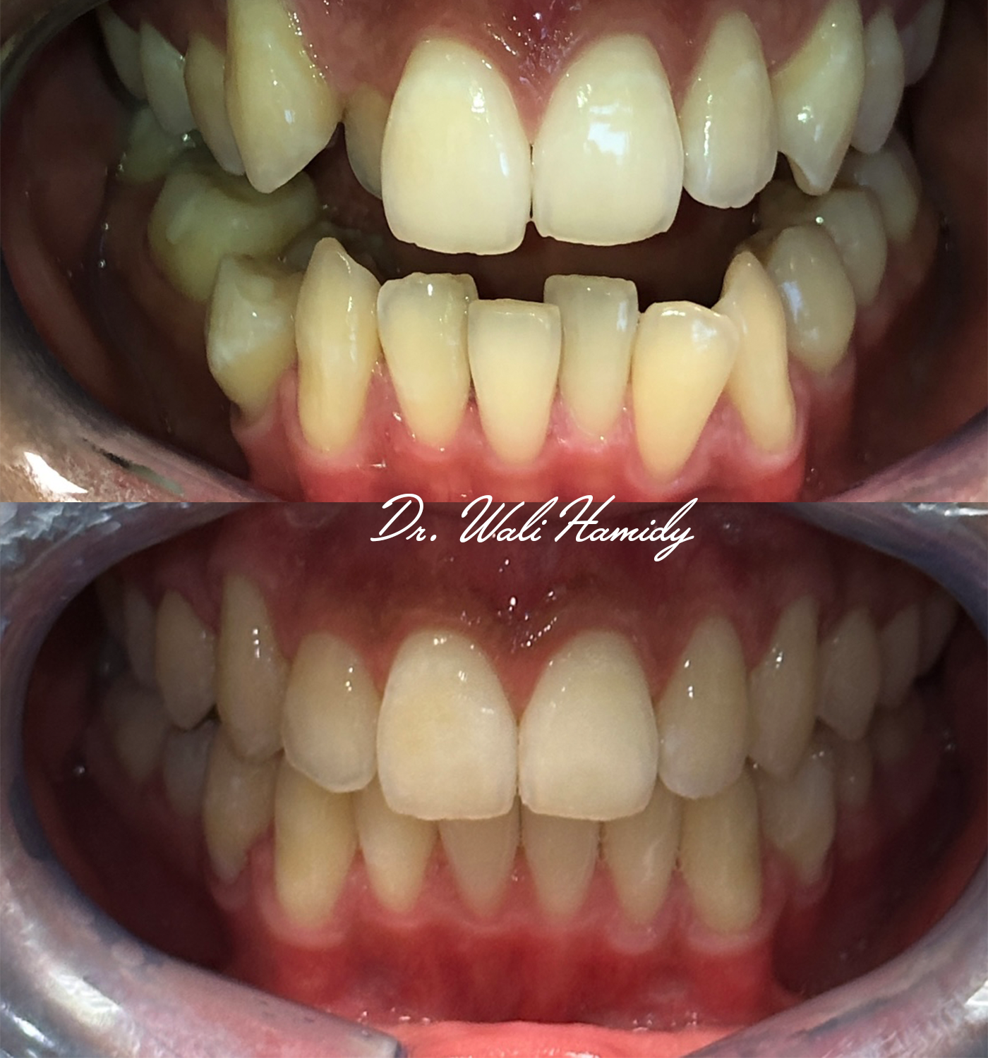 Invisalign Before & Afters