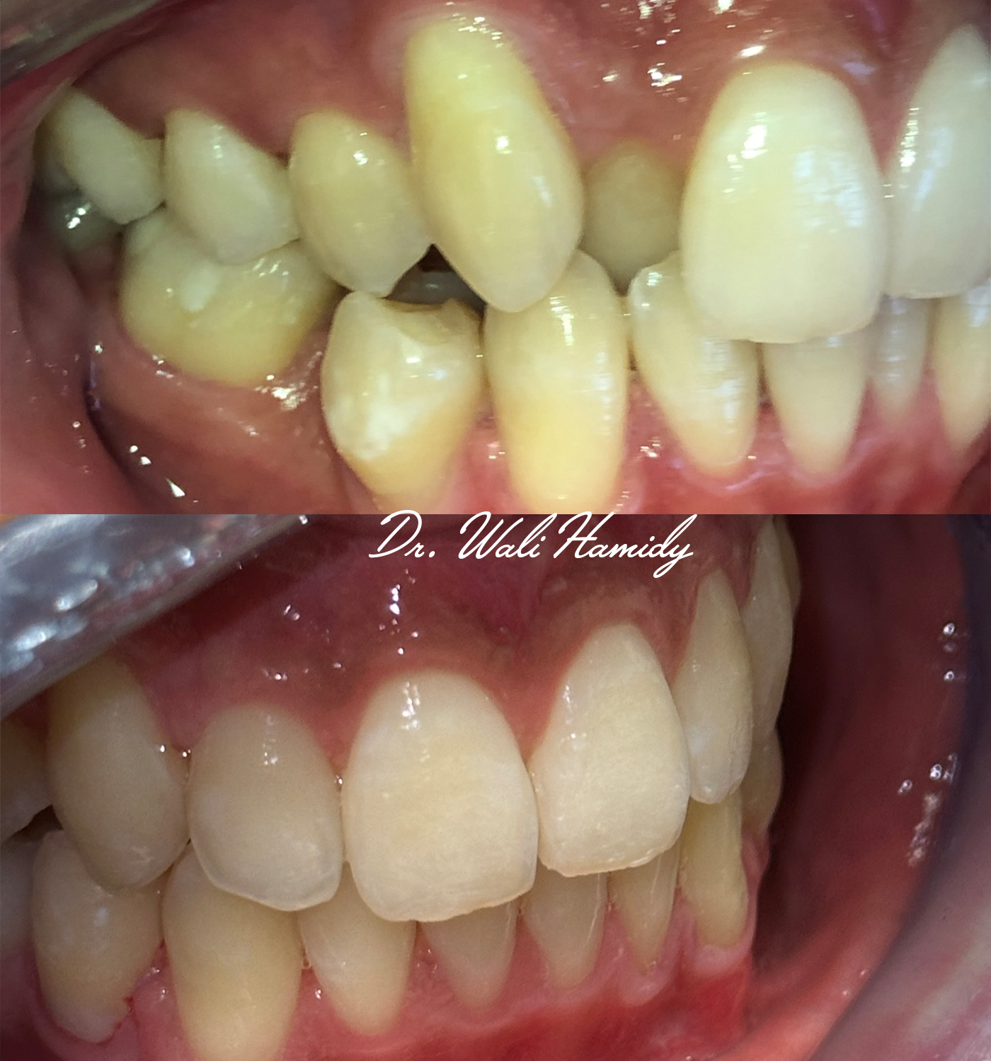 Invisalign Before & Afters