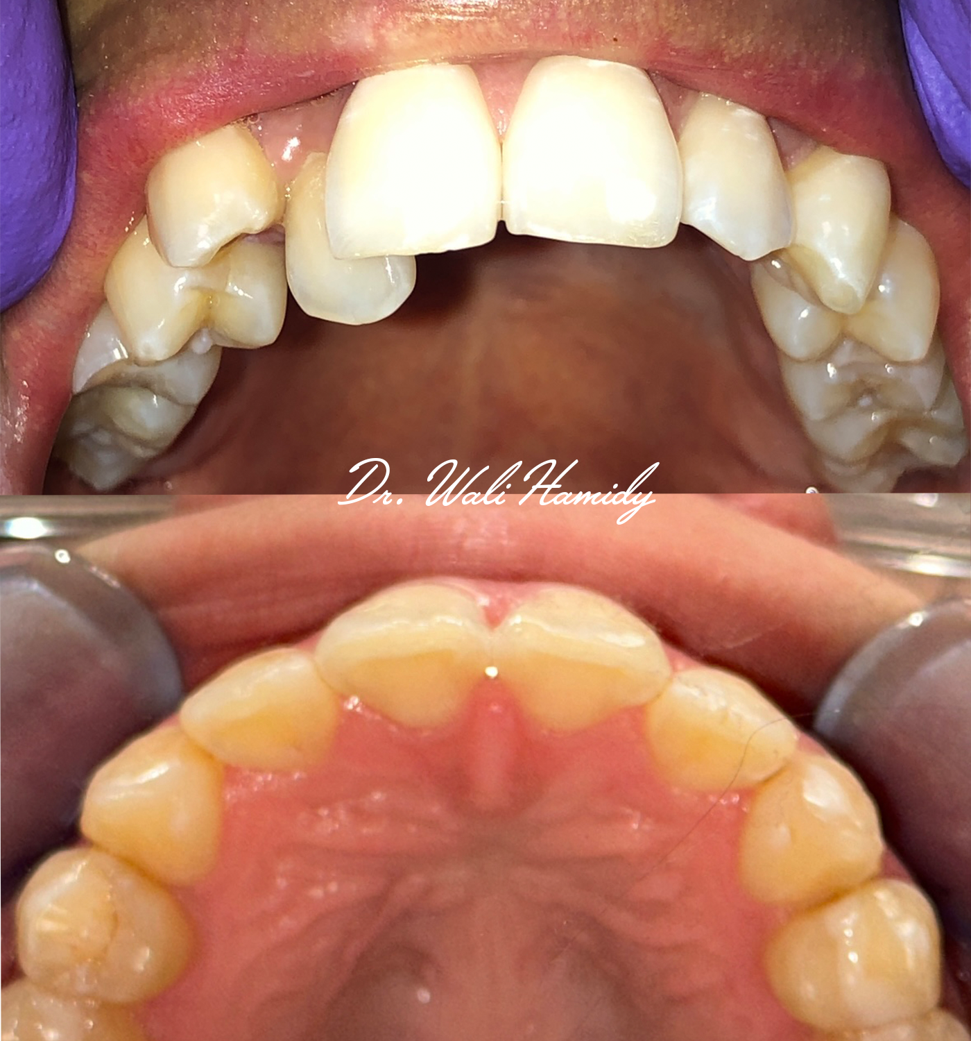 Invisalign Before & Afters