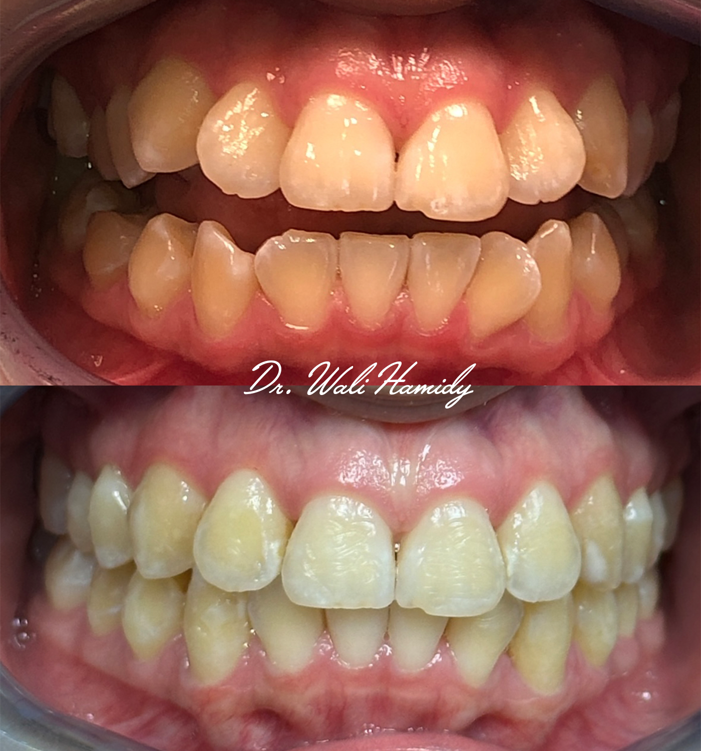 Invisalign Before & Afters