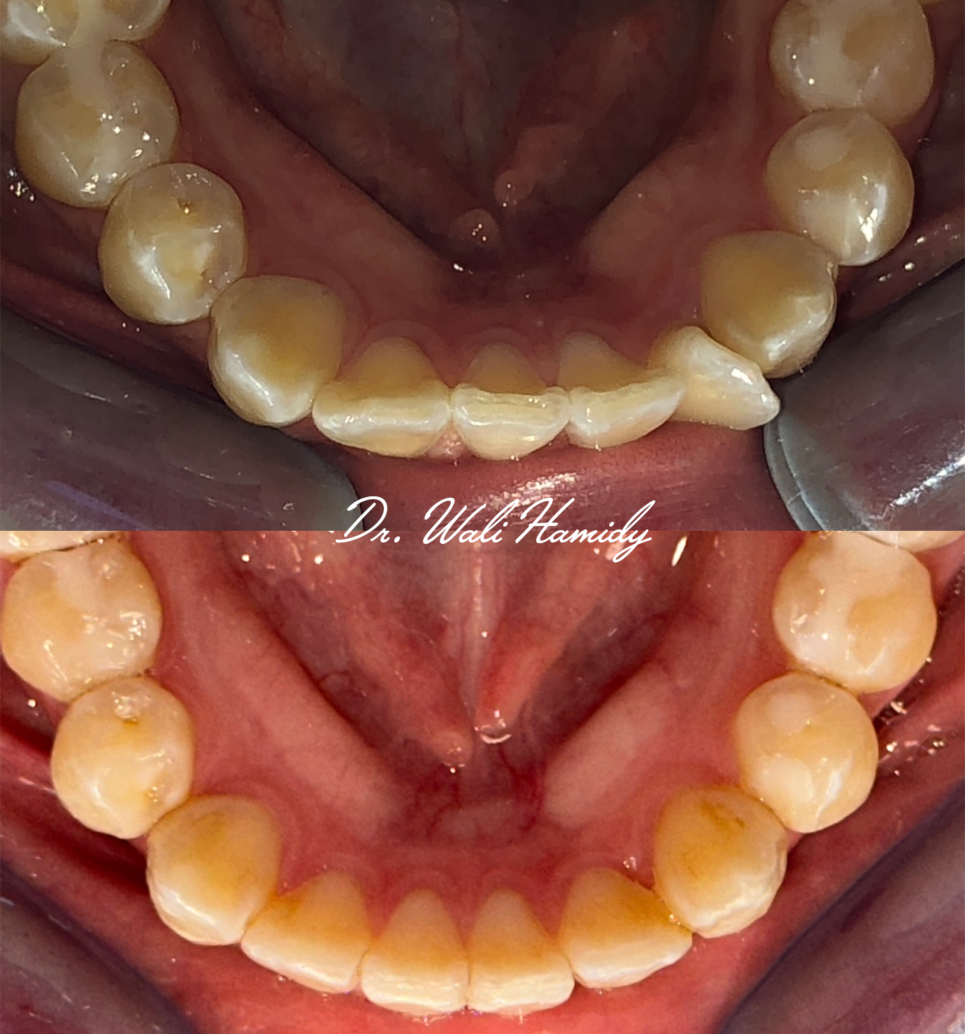 Invisalign Before & Afters