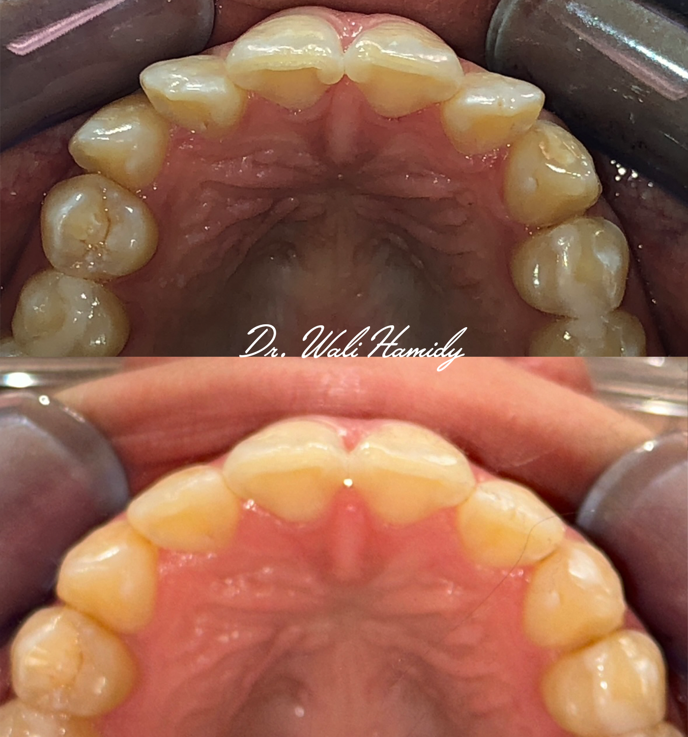 Invisalign Before & Afters