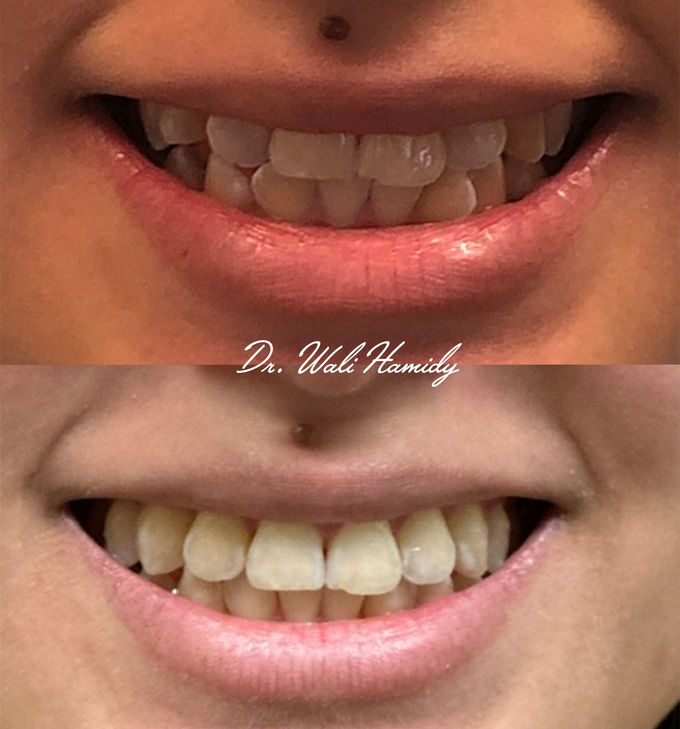 Invisalign Before & Afters