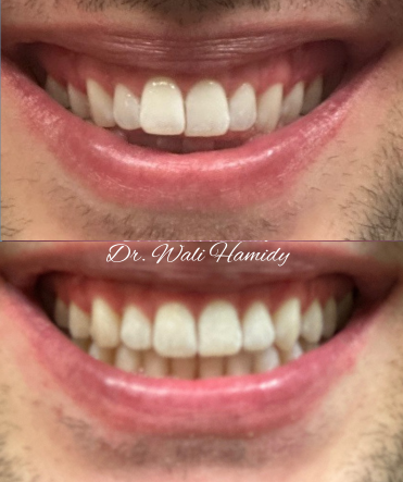 A before and after picture of a person 's teeth by dr. wali hamidy