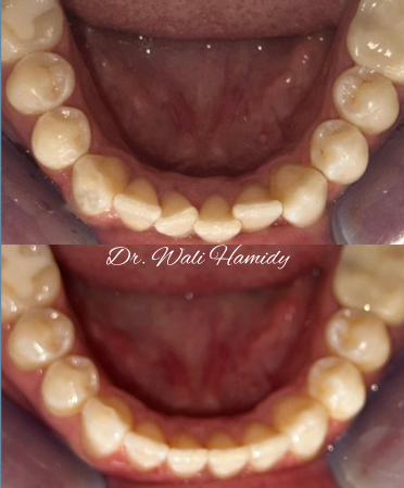 A before and after photo of a person 's teeth by dr. wali hamidy