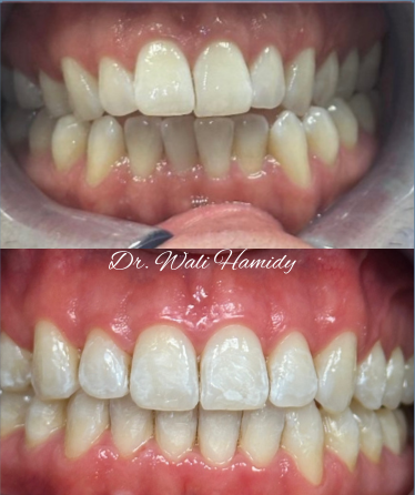 A before and after picture of a person 's teeth by dr. wali hamidy