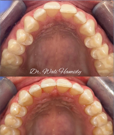A before and after photo of a person 's teeth by dr. wali hamidy