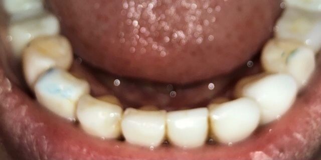 A close up of a person 's teeth with a tongue sticking out.