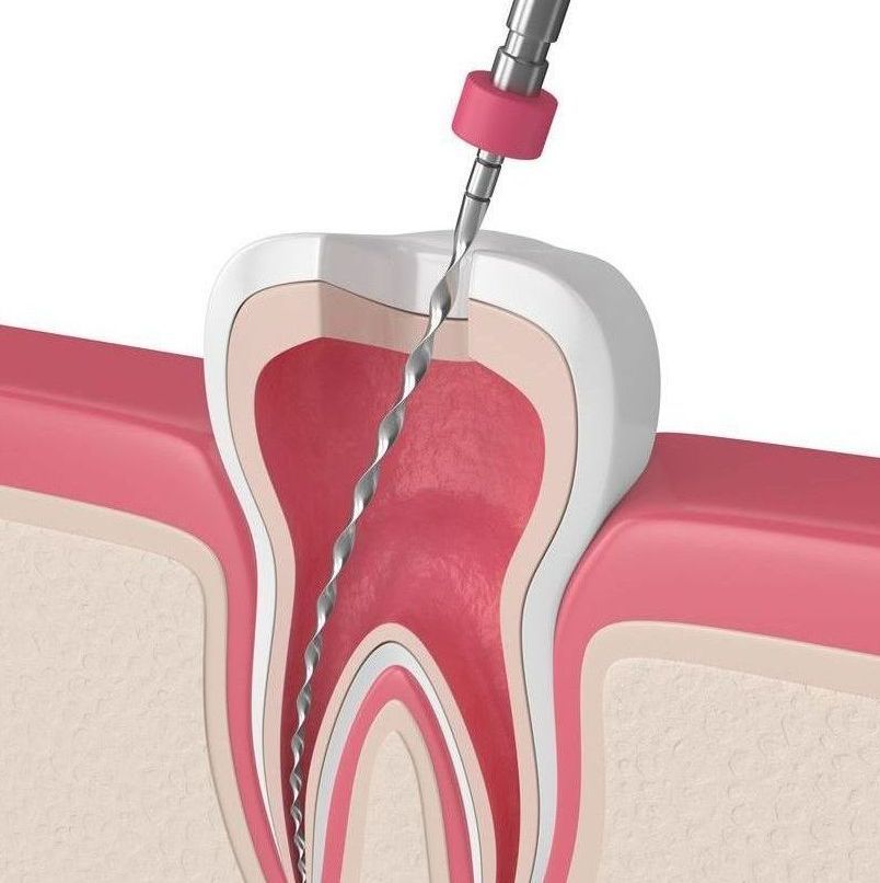 A close up of a tooth with a drill in it